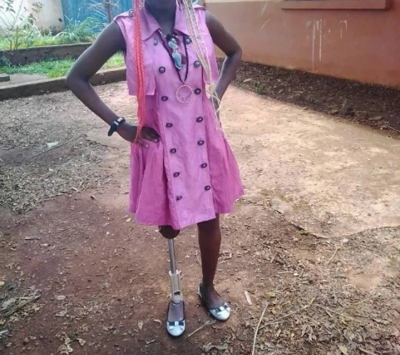Joven que podrá recibir una de las prótesis en 3D en Camerún.